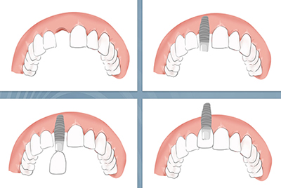 cay ghep chan rang implant