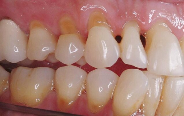 Bọc răng sứ khi cổ răng bị mòn.
