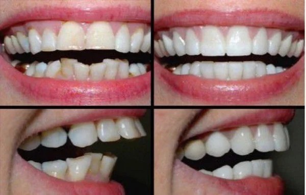 Bọc sứ khi răng cửa hô, khấp khểnh, lệch lạc.