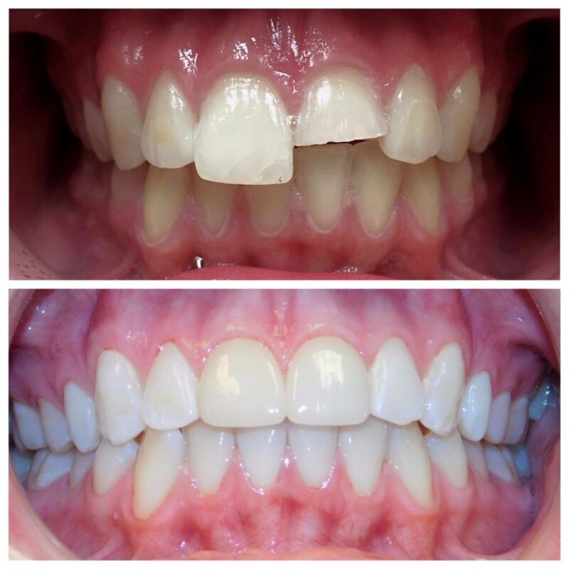 Bọc sứ răng cửa có độ bền cao.