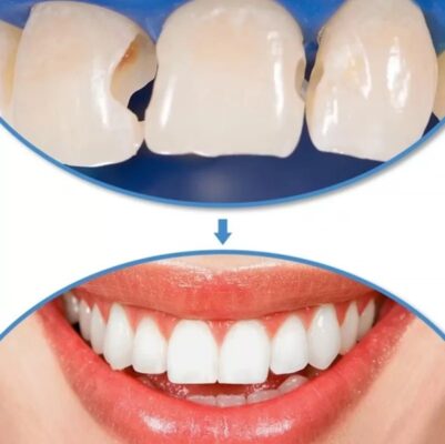 Bọc sứ răng cửa là phương pháp khắc phục khuyết điểm của răng.