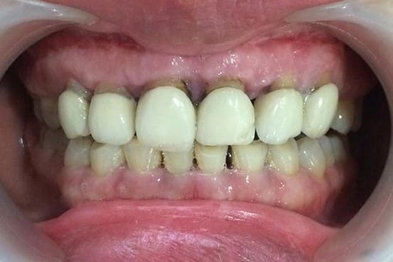 Chăm sóc răng không đúng cách cũng gây thâm nướu.