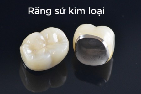 Chất liệu răng sứ kim loại kém có thể gây thâm nướu.