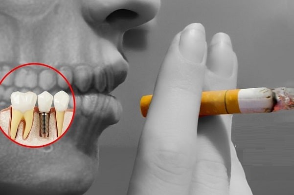 ó nhiều nguyên nhân gây nên tình trạng đào thải implant.