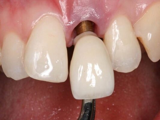 Dịch chuyển implant.