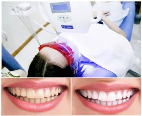 Lưu ý khi tẩy trắng răng.