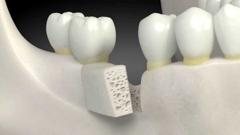Nâng xoang là một thủ thuật tăng diện tích xương