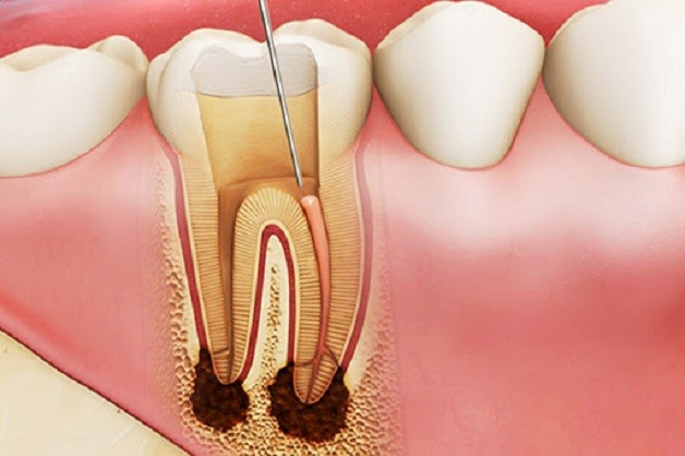 Nên bọc sứ cho những răng đã lấy tuỷ.