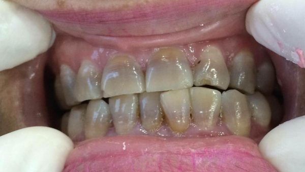 Răng bị xỉn màu có thể do nhiều nguyên nhân.