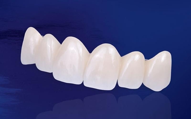 Răng sứ emax cao cấp.