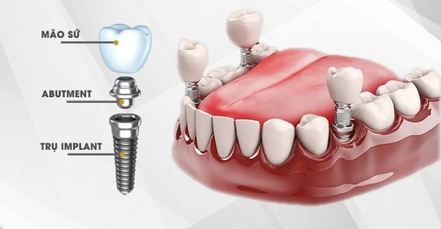 Trồng răng Implant