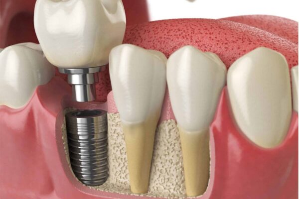 Trụ implant không tích hợp với xương hàm dẫn tới implant bị lung lay