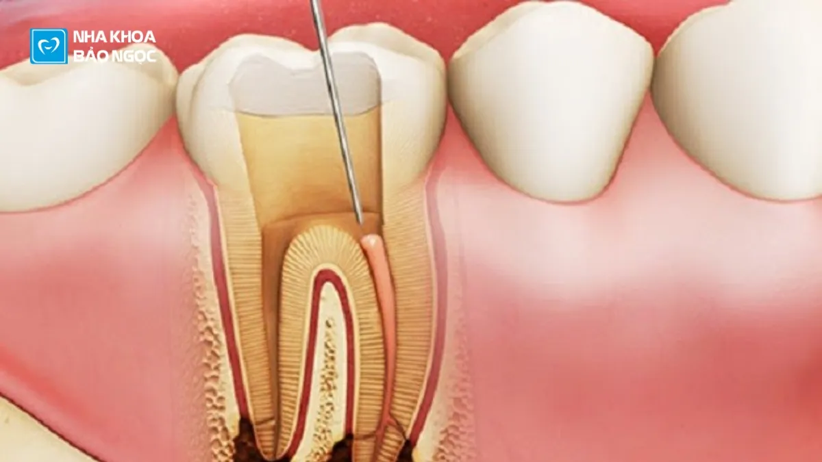 Bọc sứ răng hàm và tất tần tật những điều cần biết