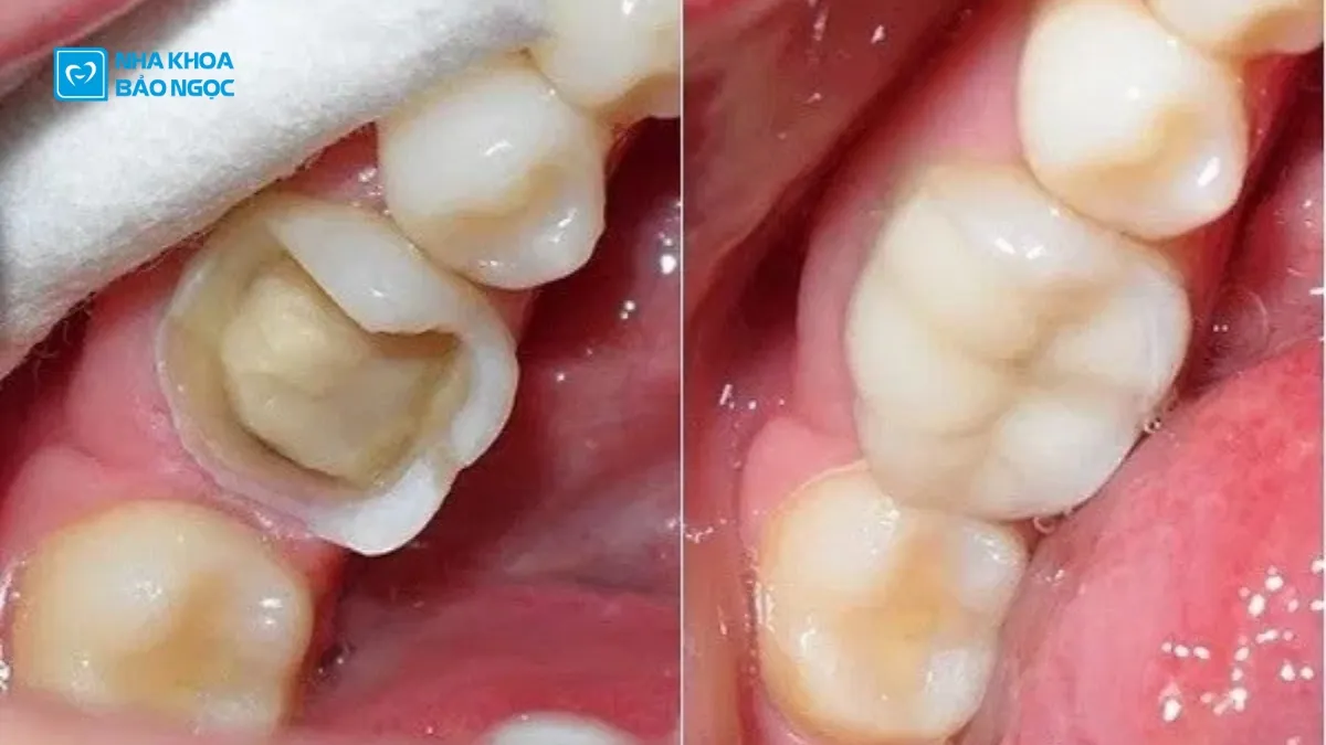 Bọc sứ răng hàm và tất tần tật những điều cần biết