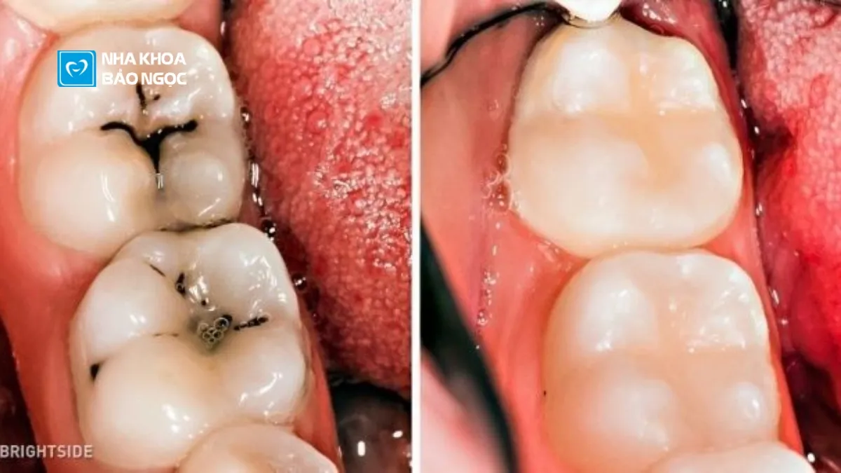 Bọc sứ răng hàm và tất tần tật những điều cần biết