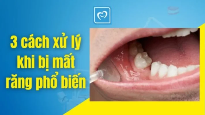 3 cách xử lý khi bị mất răng - Nha khoa Bảo Ngọc