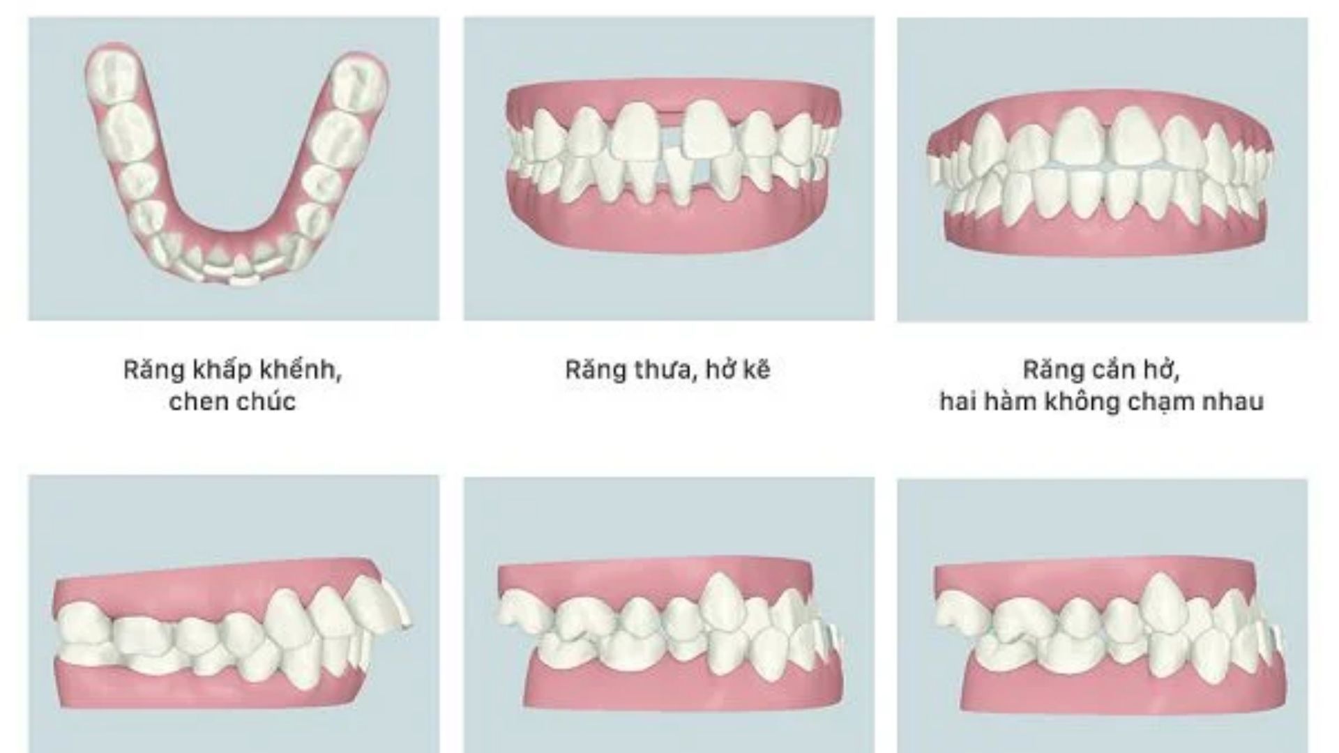 Niềng Răng Giá Rẻ tại Thái Nguyên