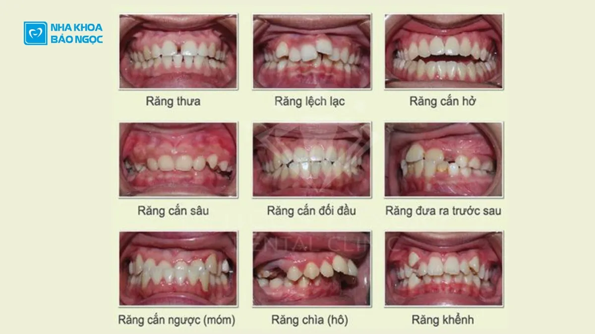 Niềng Răng Uy Tín tại Thái Nguyên | Bao nhiêu tiền? Loại nào tốt nhất?