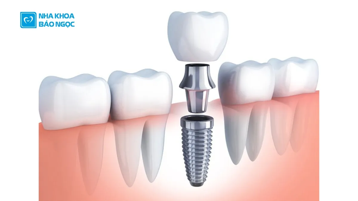 Các phương pháp trồng răng giả phổ biến nhất hiện nay