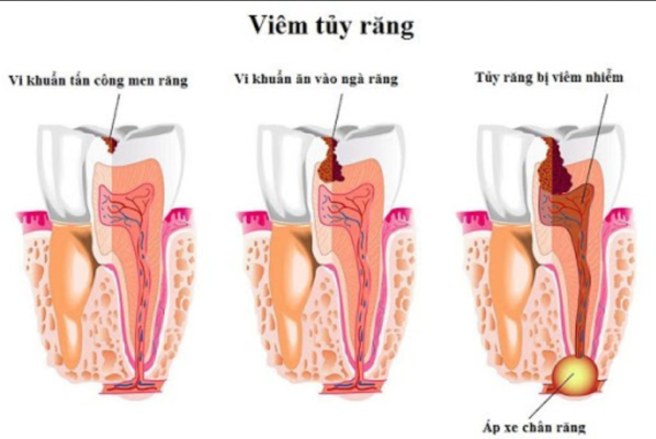 viem tuy rang