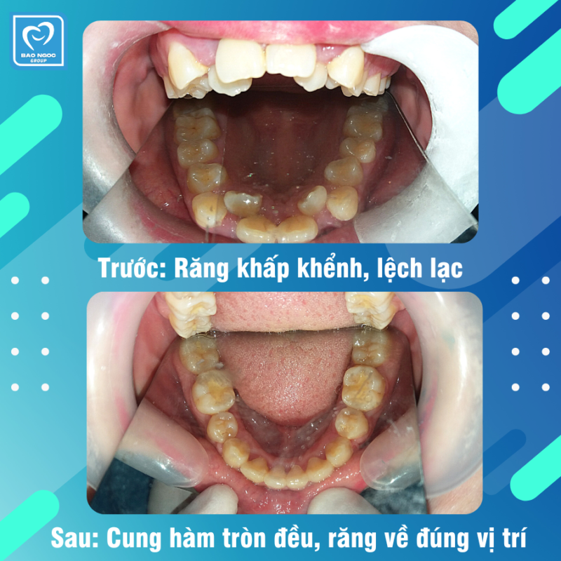 Tình trạng răng khấp khểnh lệch lạc đã được khắc phục.