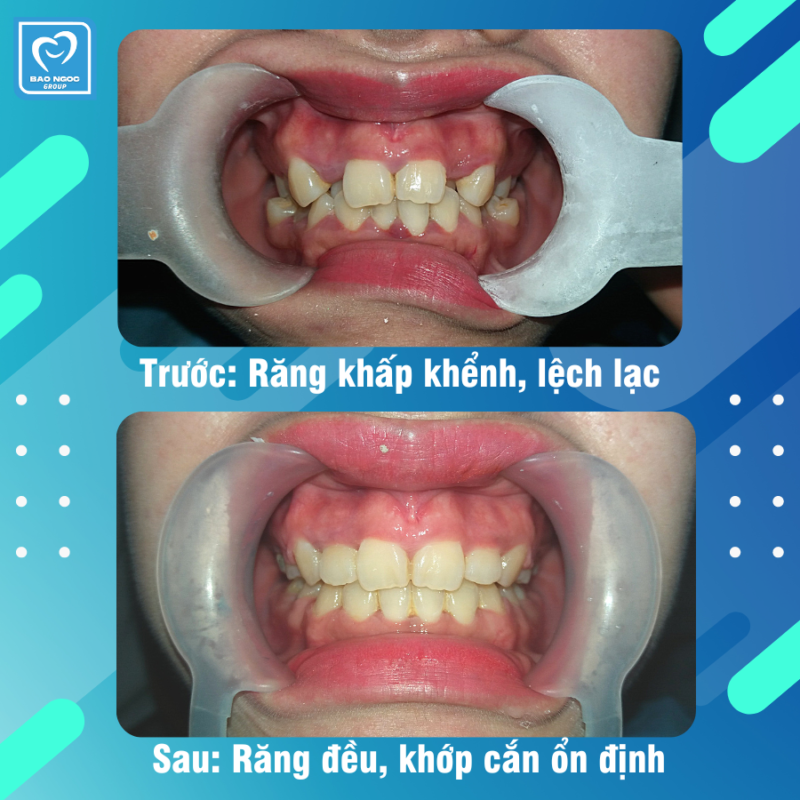 Kết quả sau hơn 1 năm chỉnh nha.