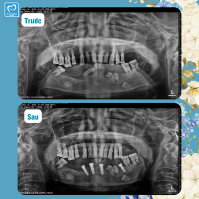 Hình ảnh trước và sau khi cấy 4 implant của chú Long.