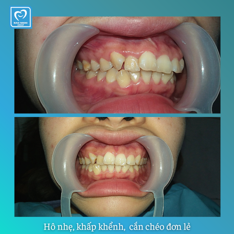 Tình trạng răng hô nhẹ, cắn chéo, khấp khểnh.