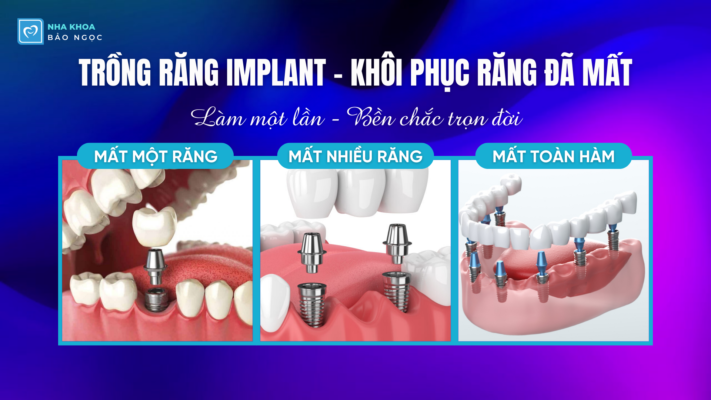 TRỒNG RĂNG IMPLANT - KHÔI PHỤC RĂNG ĐÃ MẤT