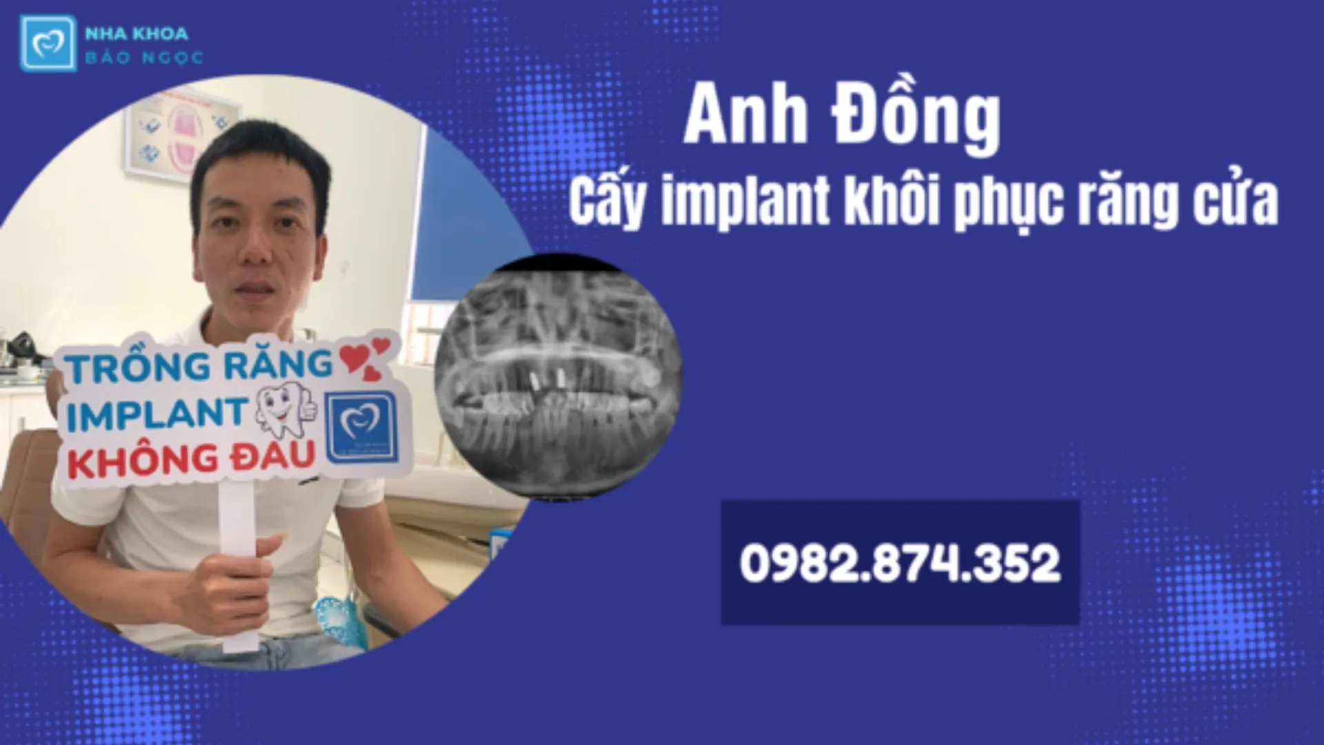 Anh Đồng – Cấy răng implant phục hồi răng mất