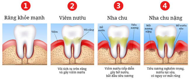 nguyen nhan chay mau nuou rang