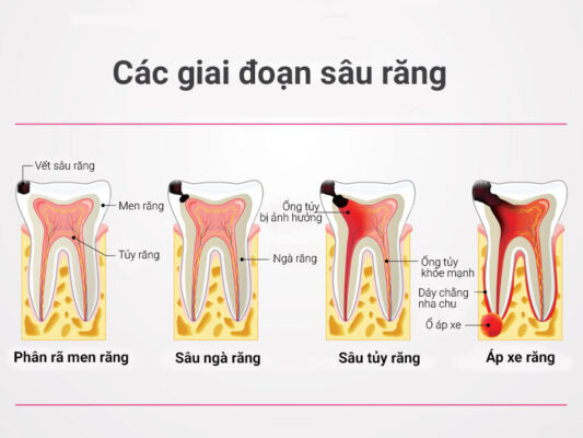 Răng bị sâu