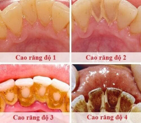 cac cap do voi rang