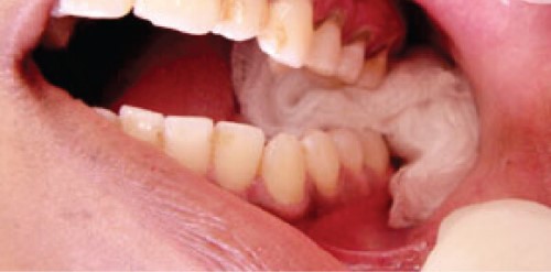 Phải làm gì khi nhổ răng bị chảy máu nhiều? Phải làm gì khi nhổ răng bị chảy máu nhiều?