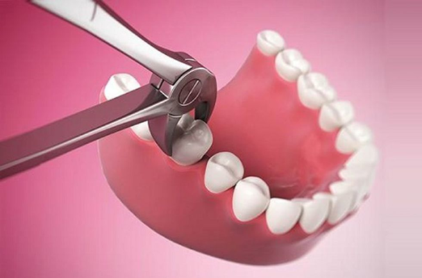 Nhổ răng khi thực sự cần thiết.