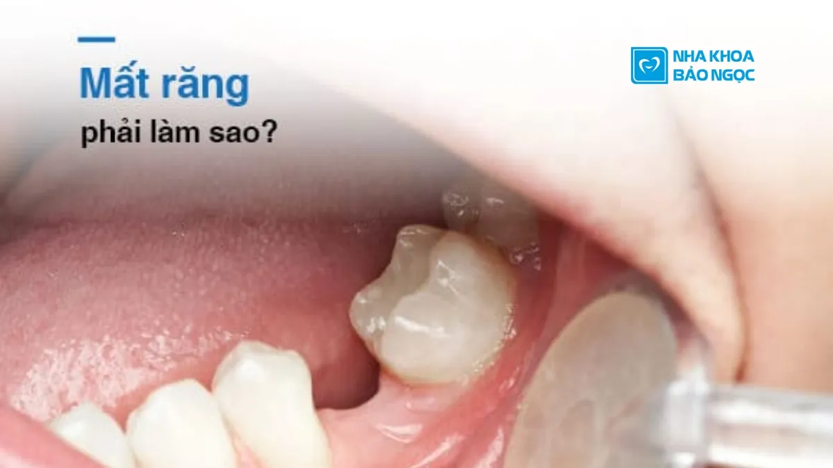 Trồng răng implant như thế nào?