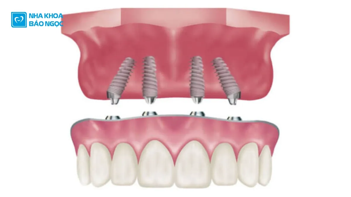 Trồng răng implant như thế nào?