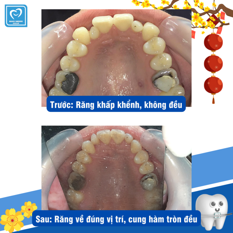 Kết quả trước và sau khi niềng răng.