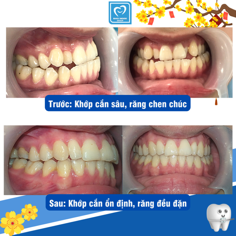 Sự thay đổi kỳ diệu khi niềng răng.