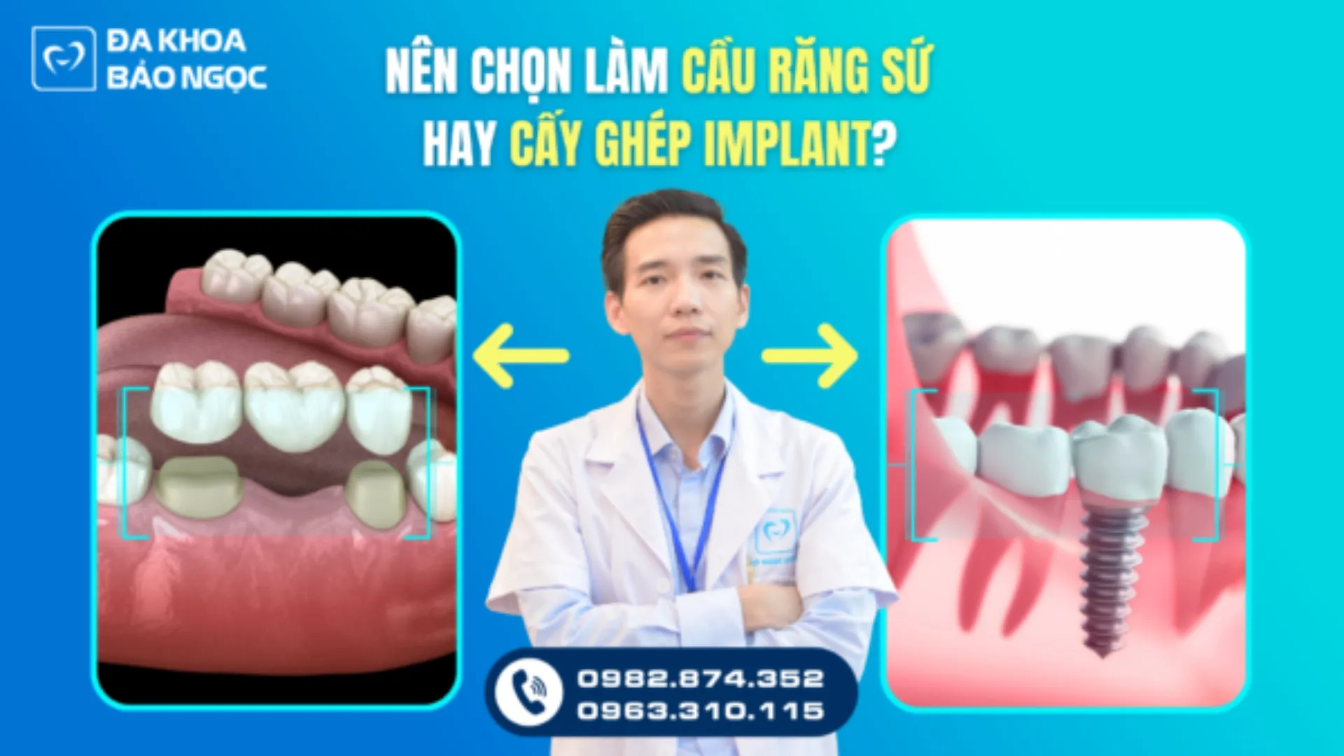 Mất răng nên chọn cấy implant hay làm cầu răng sứ?