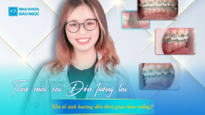 Niềng Răng Mất Thời Gian Bao Lâu?