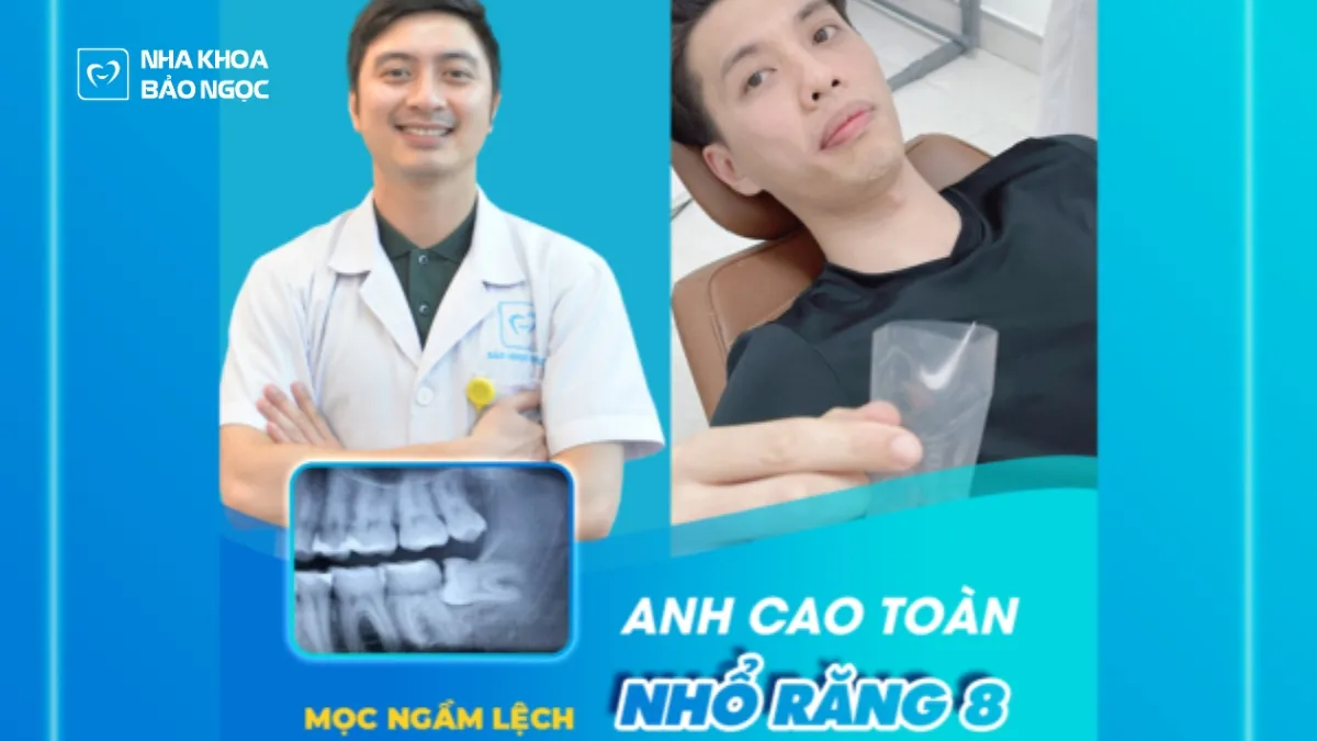 Răng khôn là gì - những điều cần biết về răng khôn?