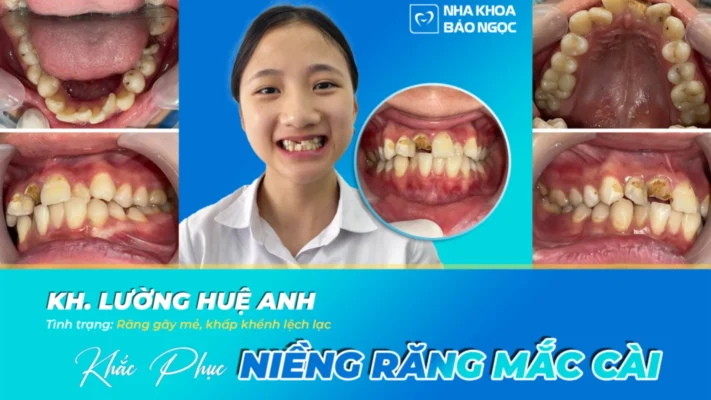 Răng khấp khểnh và hành trình cải thiện nụ cười cùng Huệ Anh 17 tuổi