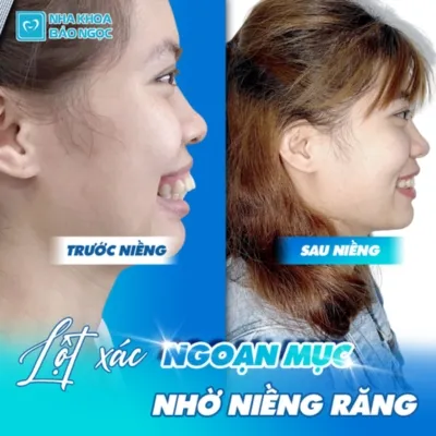 Hành trình niềng răng hô đầy thách thức và thành công của M.L 25 tuổi