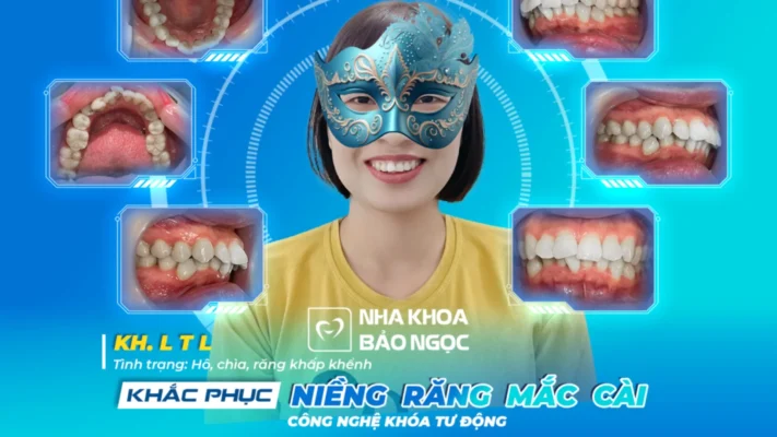 Niềng răng công nghệ 4.0 với nhiều ưu đãi cùng T.L