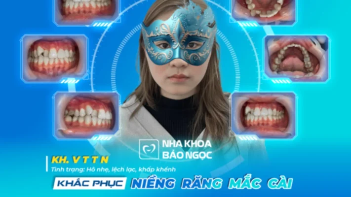Niềng răng để khoẻ và đẹp số 1 cùng T.N