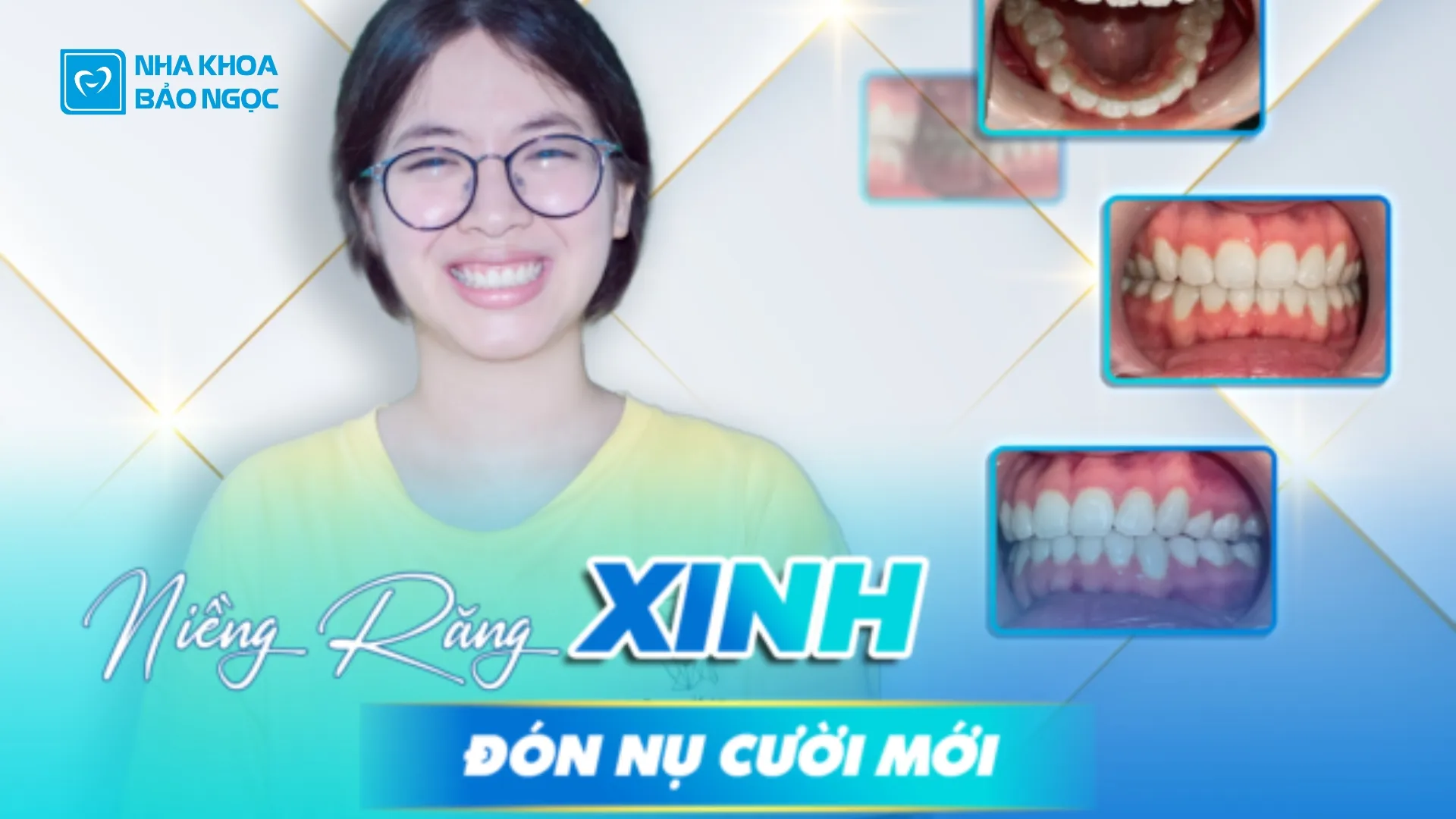 Có nên niềng răng khểnh không?