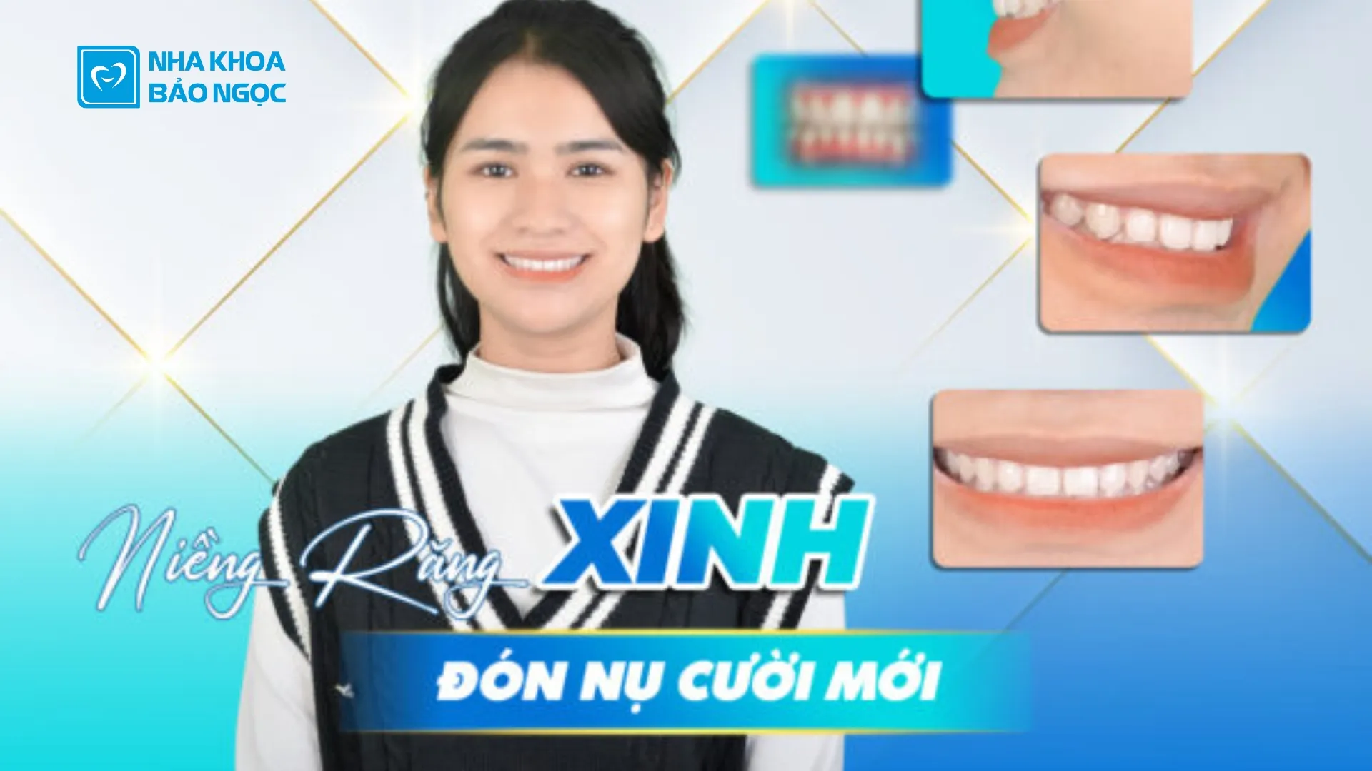 Niềng răng thành công cùng Bích Lệ 2003