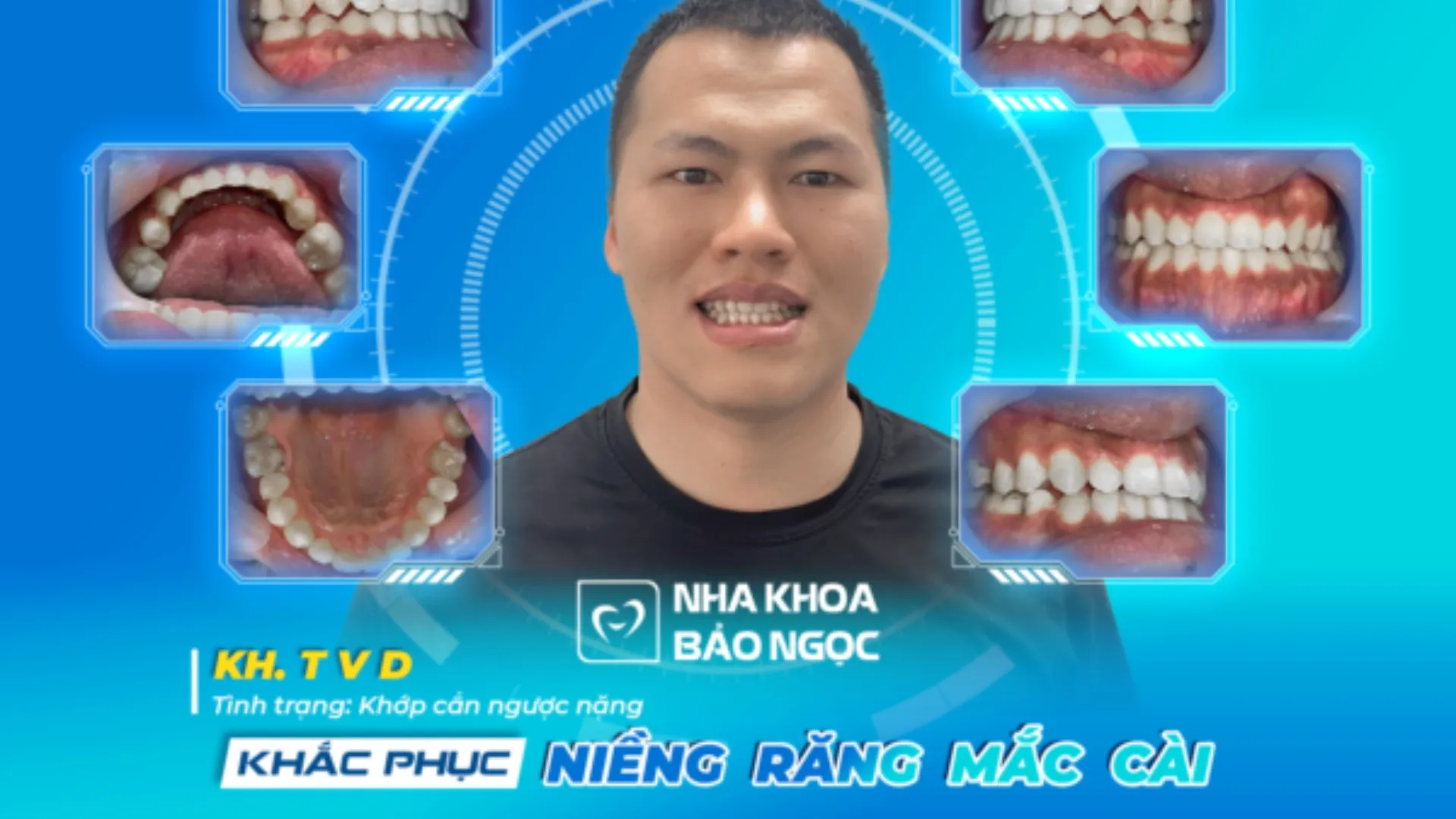 Case niềng răng có 1 không 2 của Văn Đức