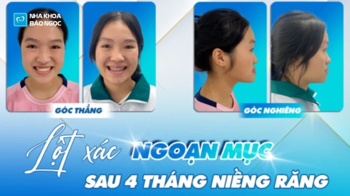 Niềng răng ấn tượng với mục tiêu 2 năm, hoàn thành chỉ sau 4 tháng cùng Hương Giang